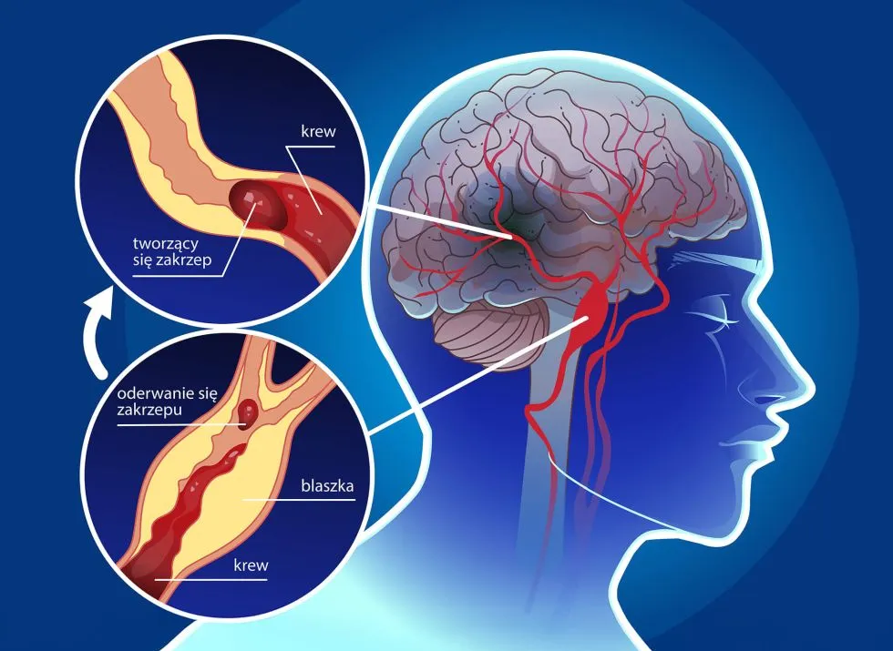Udar mózgu – przyczyny, objawy i skutki, których nie możesz ignorować