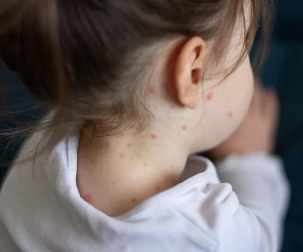Jak zapobiec ospie po kontakcie z chorym i uniknąć zakażenia