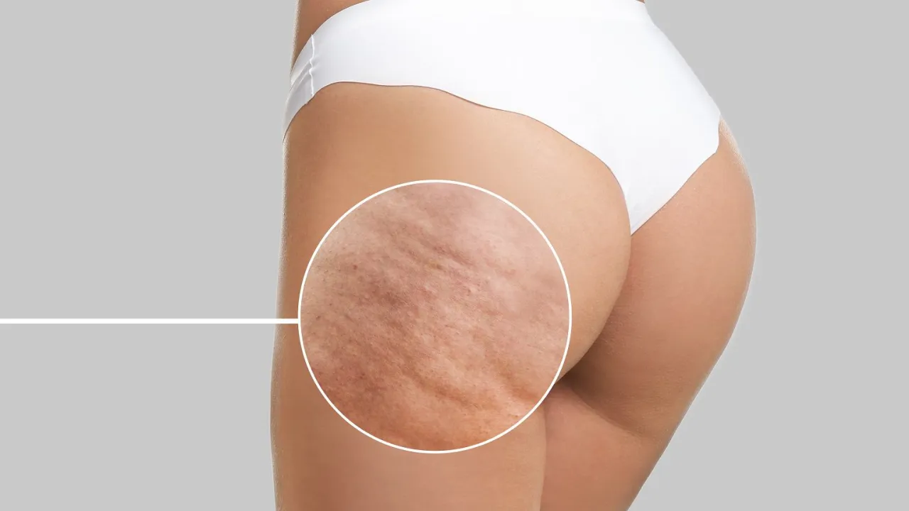 Gładkie uda bez cellulitu: sprawdzone domowe i profesjonalne metody