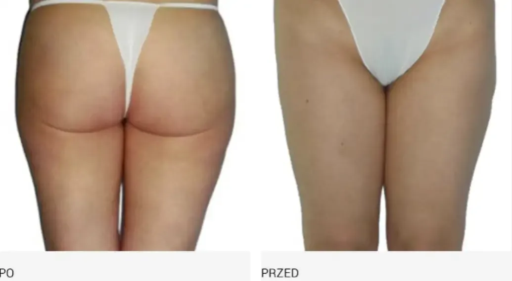 Endermologia: Ile cm stracisz? Realne efekty i wskazówki