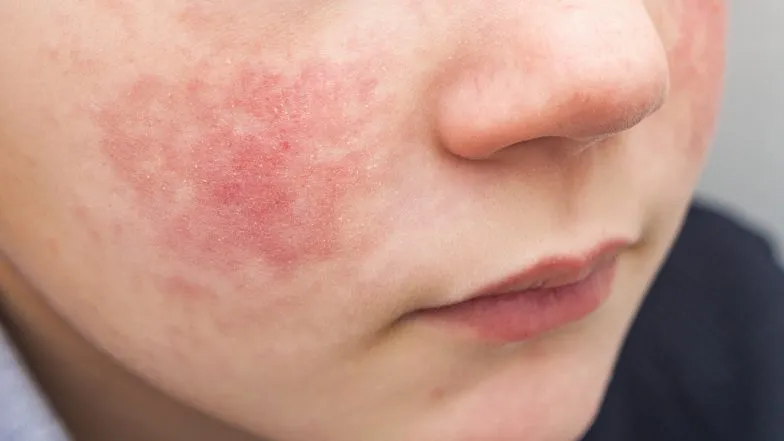 Uczulenie na twarzy dziecka - skuteczne sposoby na łagodzenie objawów