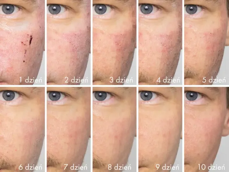 Jak wygląda twarz po laserze frakcyjnym? Efekty i objawy po zabiegu