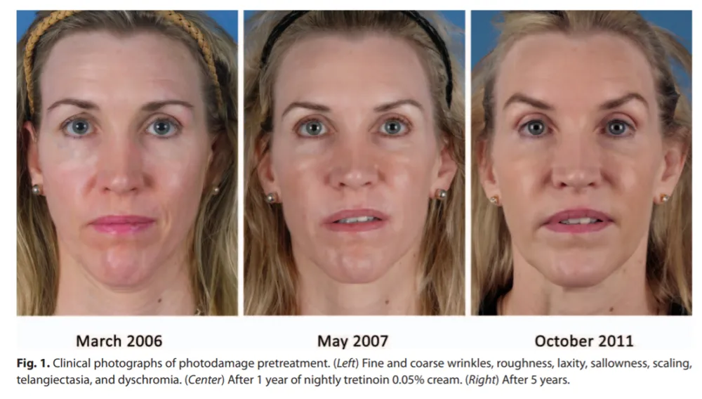 Retinol lek na co? Odkryj jego skuteczność w leczeniu skóry