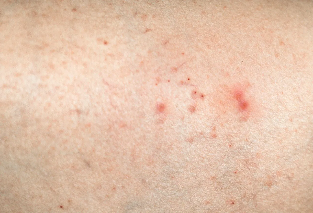 Atopowe zapalenie skóry u dorosłych – co warto wiedzieć?