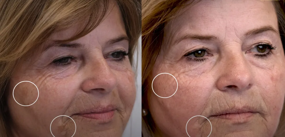 Czy po laserze frakcyjnym można się malować? Ważne zasady i porady