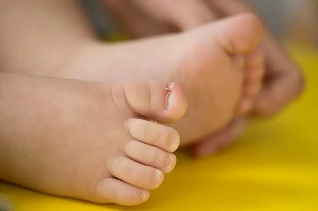 Wrastający paznokieć u niemowlaka: 7 skutecznych metod leczenia
