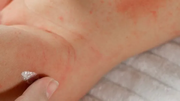 Czym smarować potówki u niemowlaka: 7 skutecznych sposobów