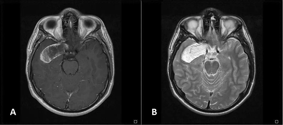 Czy torbiel u niemowlaka się wchłonie? Prawda o cystach i ich losie Czy torbiel u niemowlaka się wchłonie? Prawda o cystach i ich losie