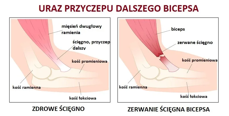 Naderwany biceps - objawy, które powinny cię zaniepokoić
