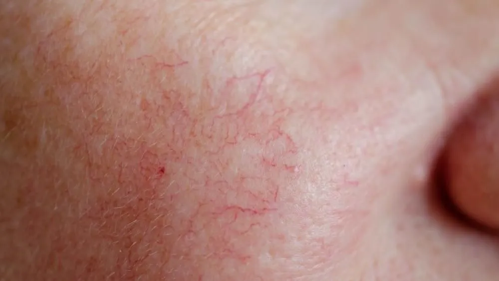 Cera naczynkowa: objawy, przyczyny i jak o nią dbać?