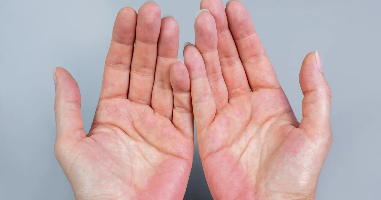Czerwone dłonie od wewnątrz przyczyny: objawy, które mogą zaskoczyć