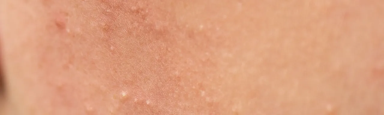 Jak wygląda zapchana cera i jak ją skutecznie wyleczyć?