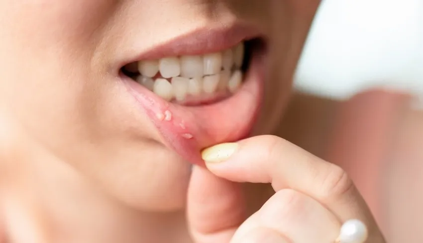 Przyczyna powstawania aft w jamie ustnej – co musisz wiedzieć, aby uniknąć bólu