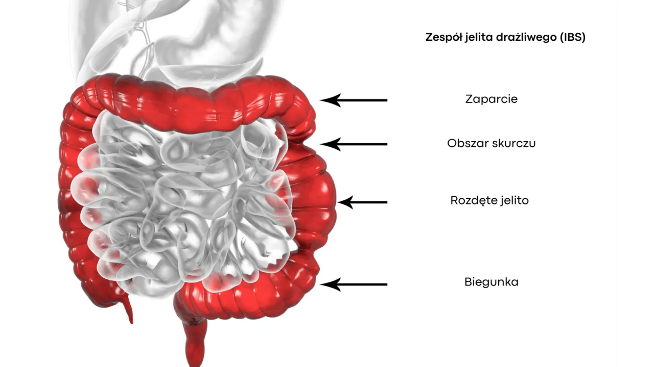 Zespół jelita drażliwego objawy – co powinieneś wiedzieć z forum