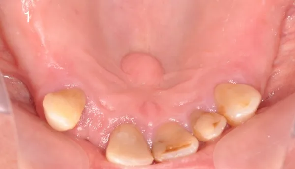 Jak wygląda włókniak w jamie ustnej? Objawy, przyczyny i leczenie