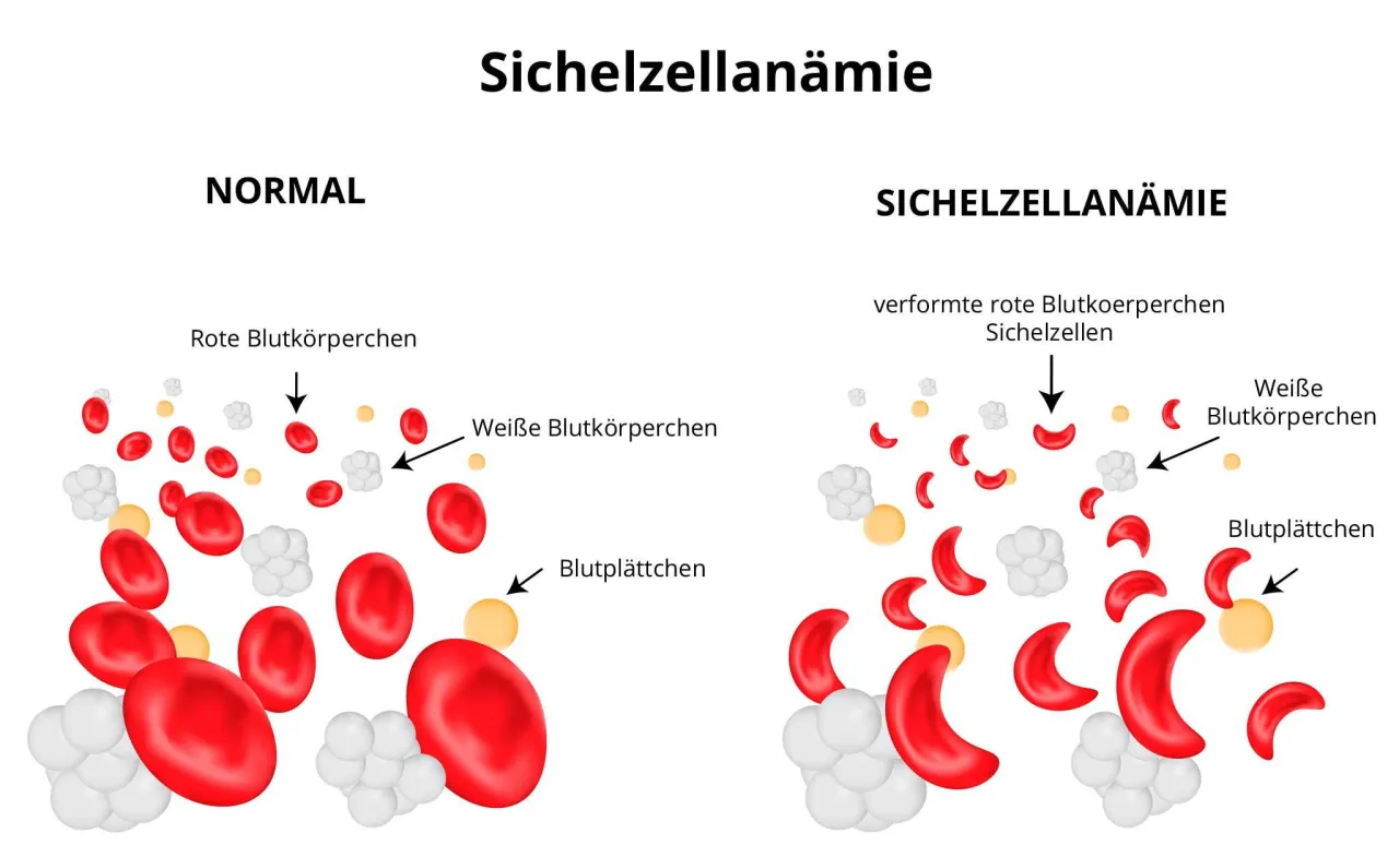 Sichelzellanämie Diagnose: Labor, Tests & Gentest erklärt