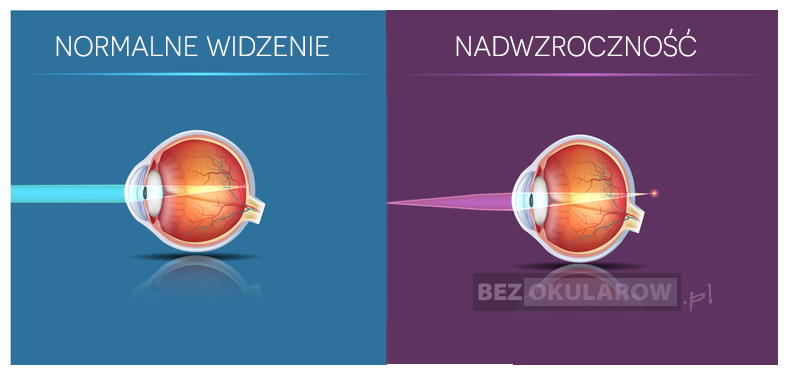 Plusy na recepcie? Zrozum dalekowzroczność i jak ją korygować