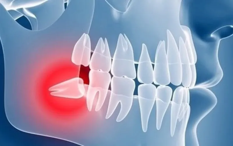 Kiedy nie można wyrwać zęba? Poznaj groźne przeciwwskazania