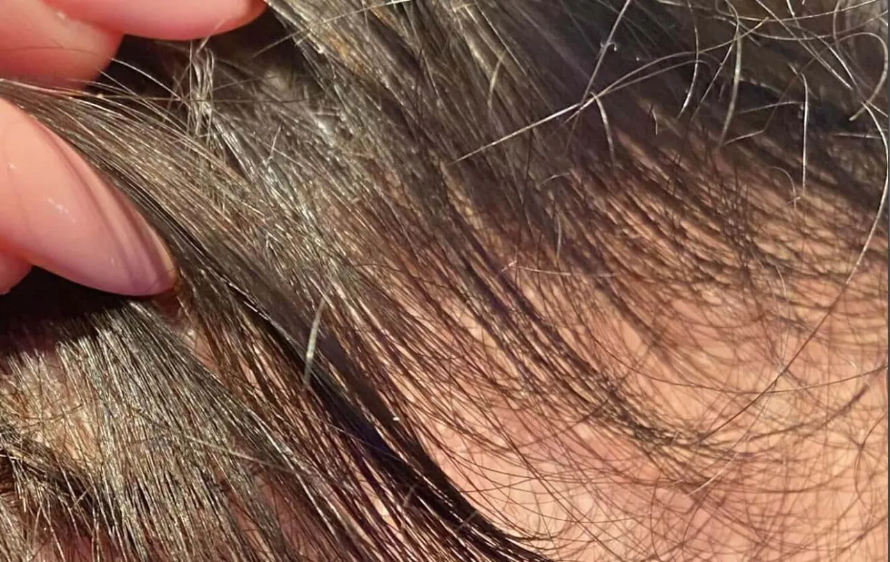 Wypadanie włosów u 15-latki: przyczyny i skuteczne leczenie