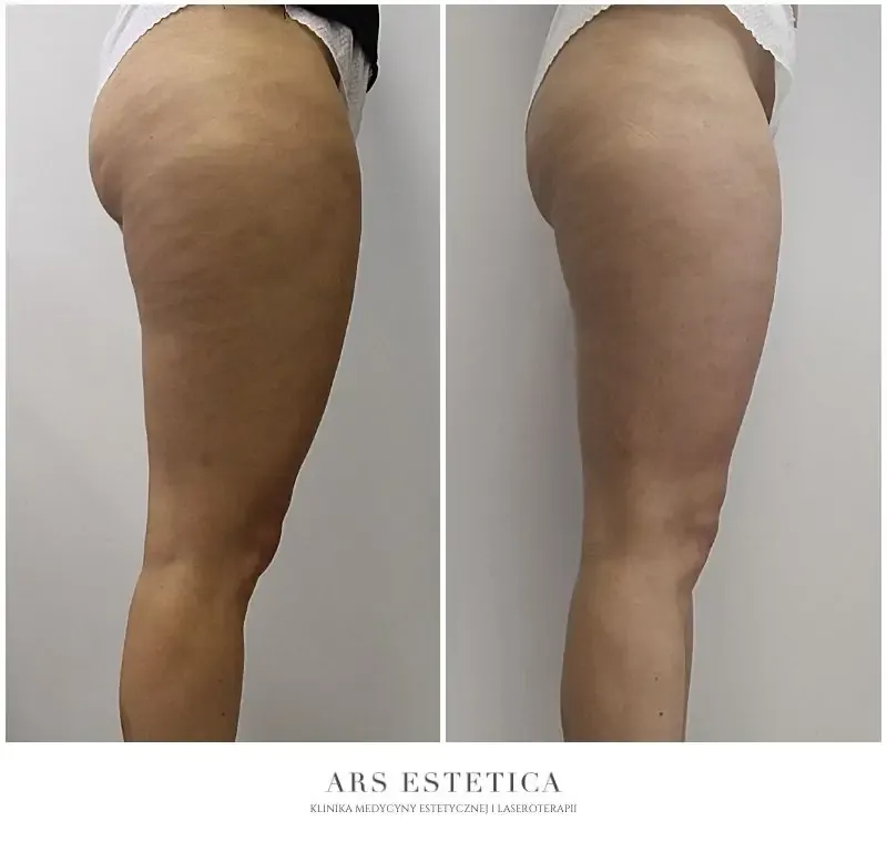 Skuteczny zabieg na cellulit? Poznaj typ i wybierz idealny!