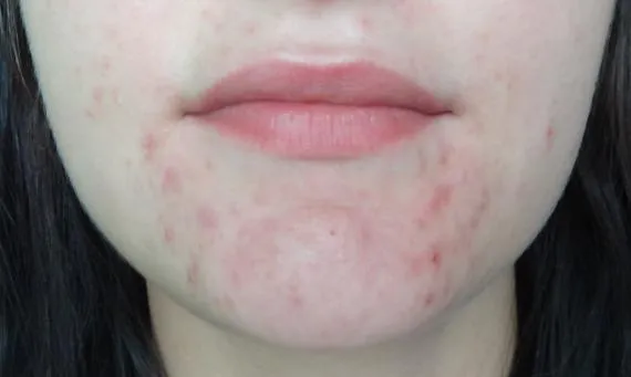 Skutki uboczne po odstawieniu Tetralysal – co musisz wiedzieć?