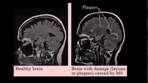 Filmy o stwardnieniu rozsianym: jak zrozumieć chorobę i jej wpływ na życie