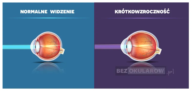 Jak widzi krótkowidz? Poznaj objawy i metody korekcji