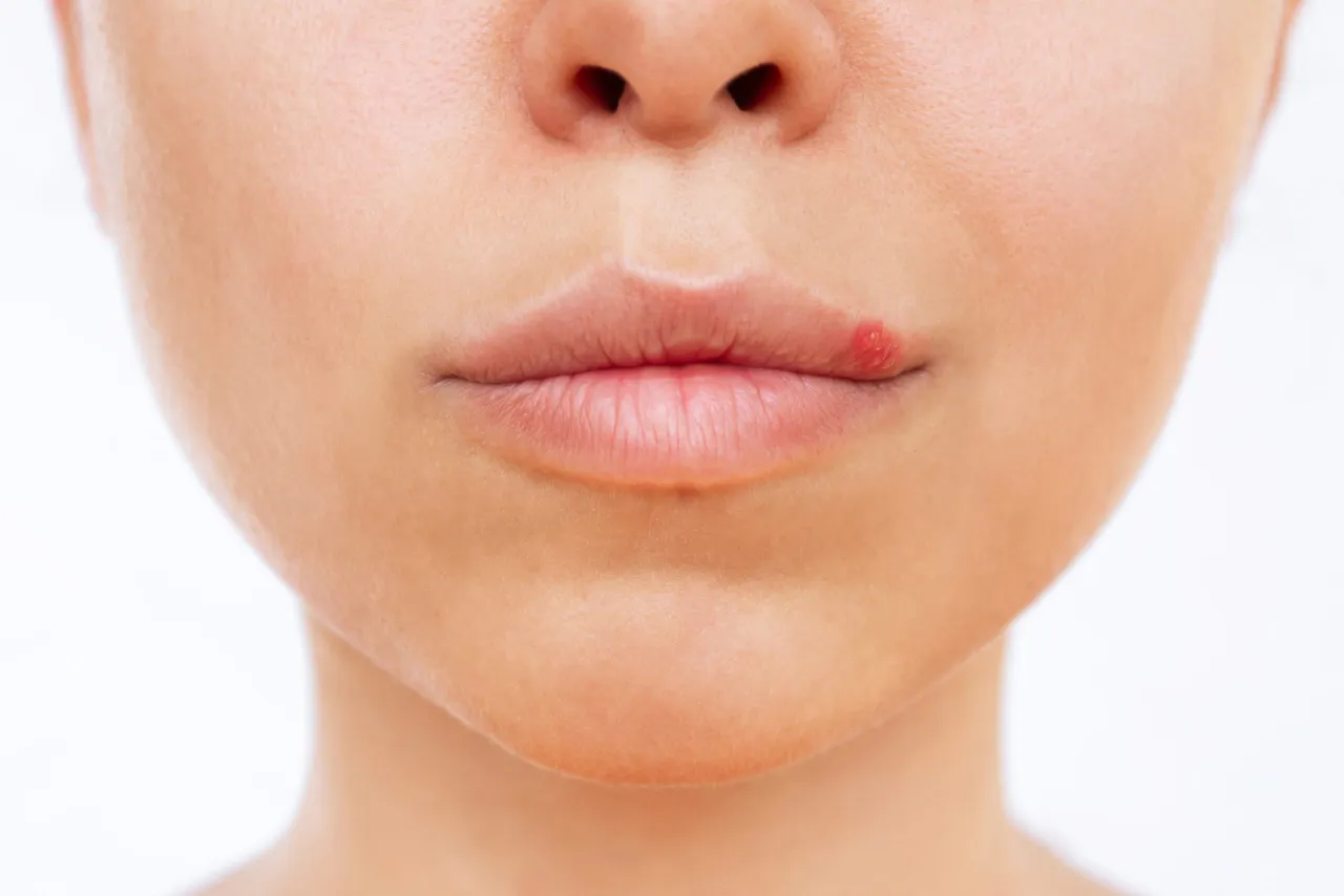 Jak zapobiec opryszczce: skuteczne metody na unikanie nawrotów