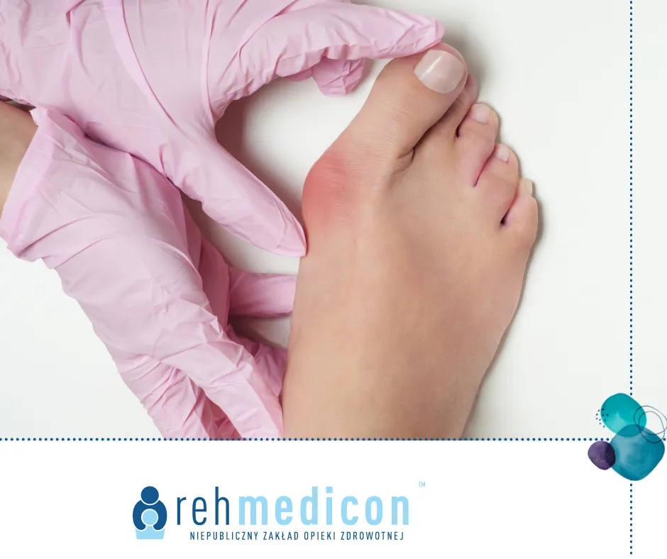 Czy haluksy muszą boleć? Skuteczne sposoby na ból palucha koślawego.