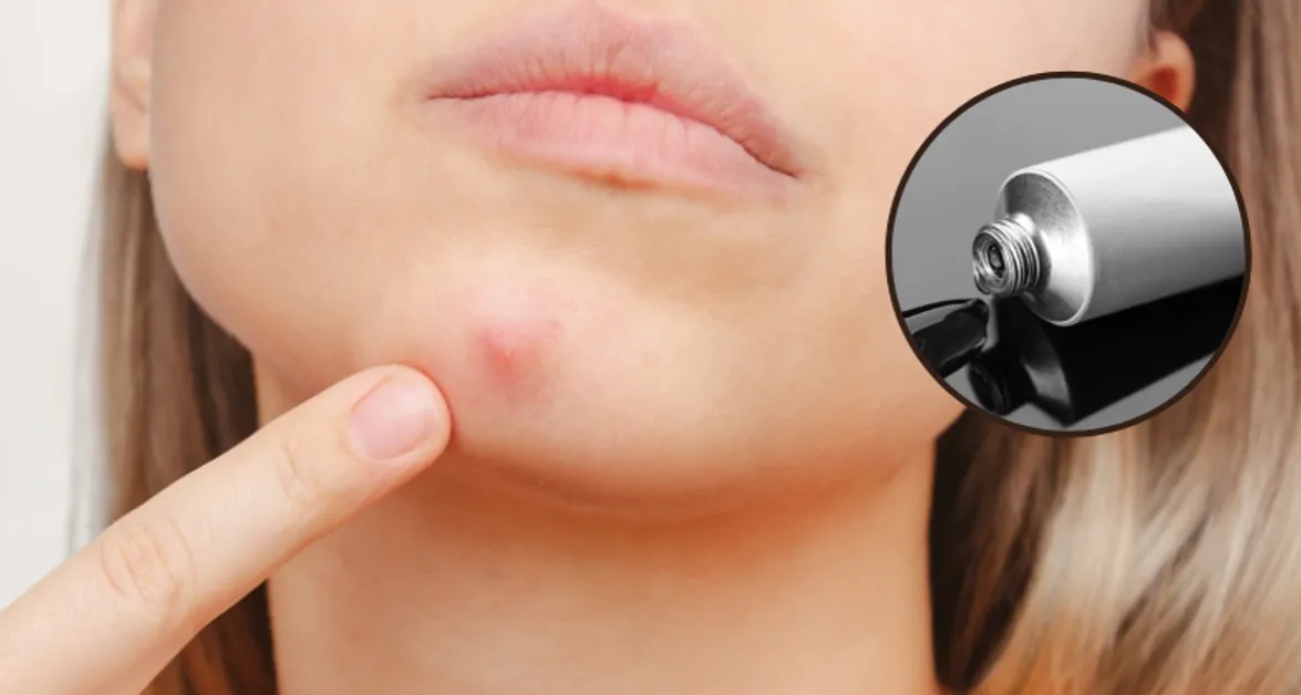 Jak pozbyć się pryszcza, który jeszcze nie wyszedł, bez wyciskania