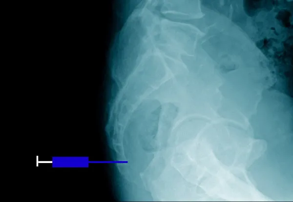 Jakie leki na ból kości ogonowej mogą naprawdę pomóc w ulgach?