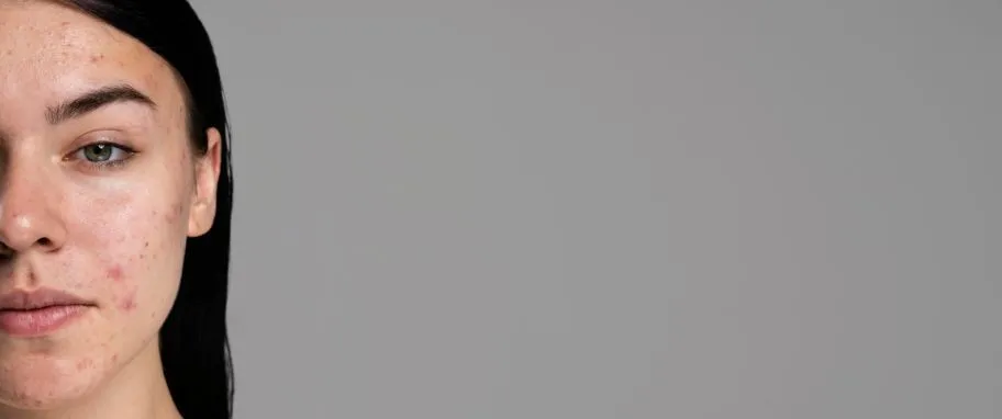 Kremy na niedoskonałości skóry – skuteczne rozwiązania na trądzik i pory
