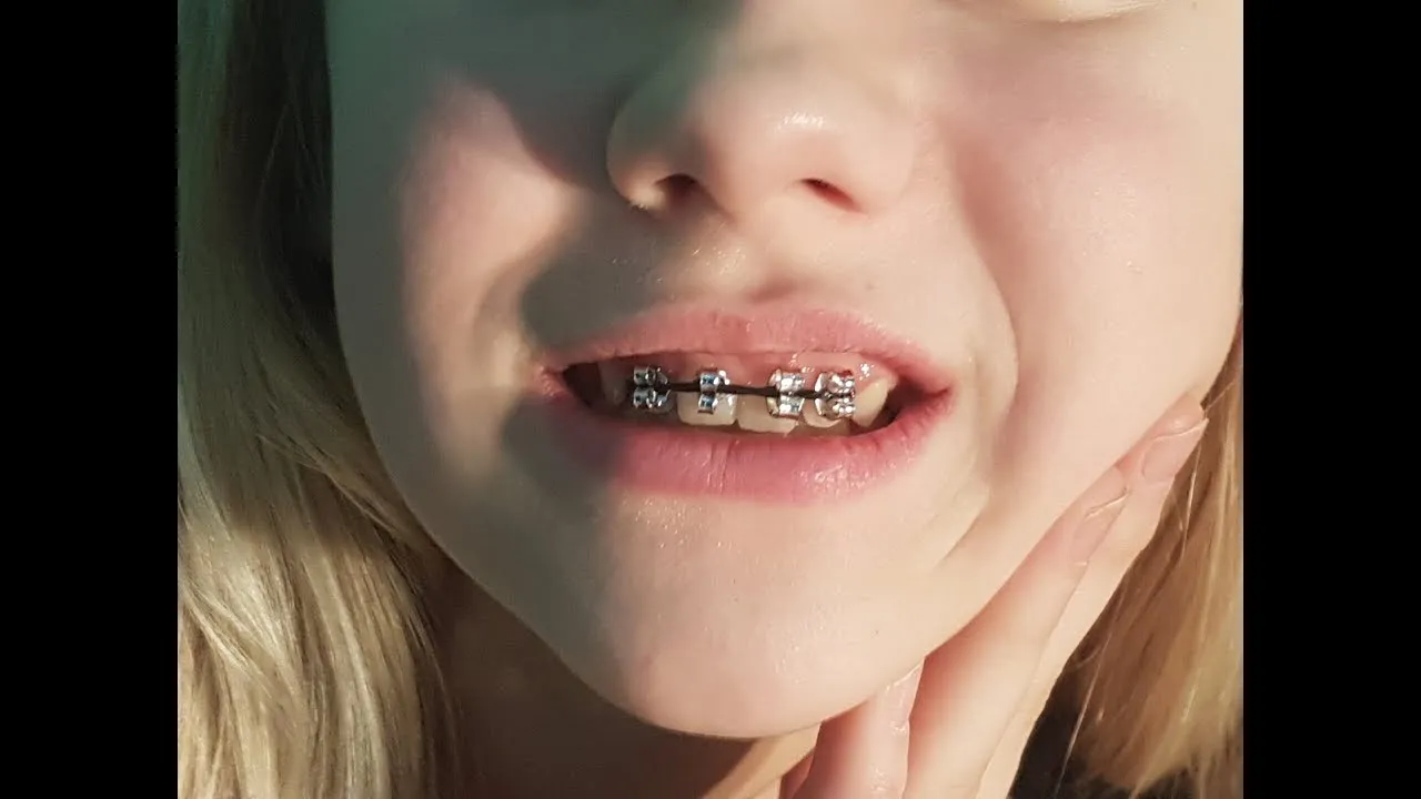 Jak zrobić sztuczny aparat na zęby w prosty sposób i z tanich materiałów