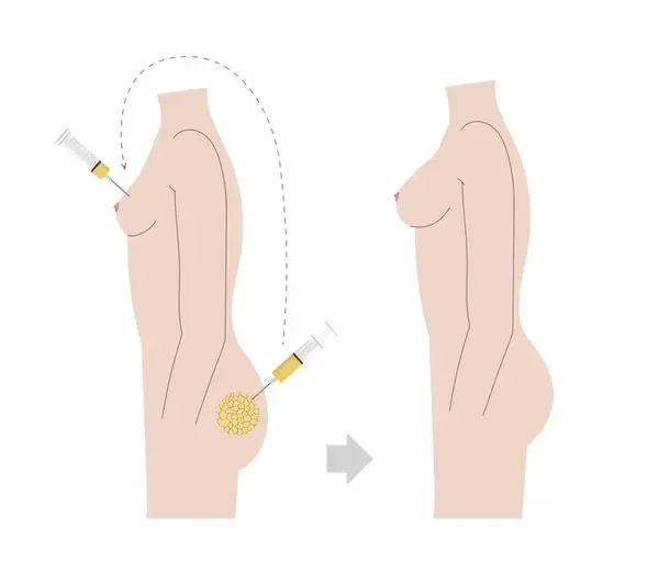 Lipofilling biustu – czy warto? Opinie i doświadczenia kobiet.