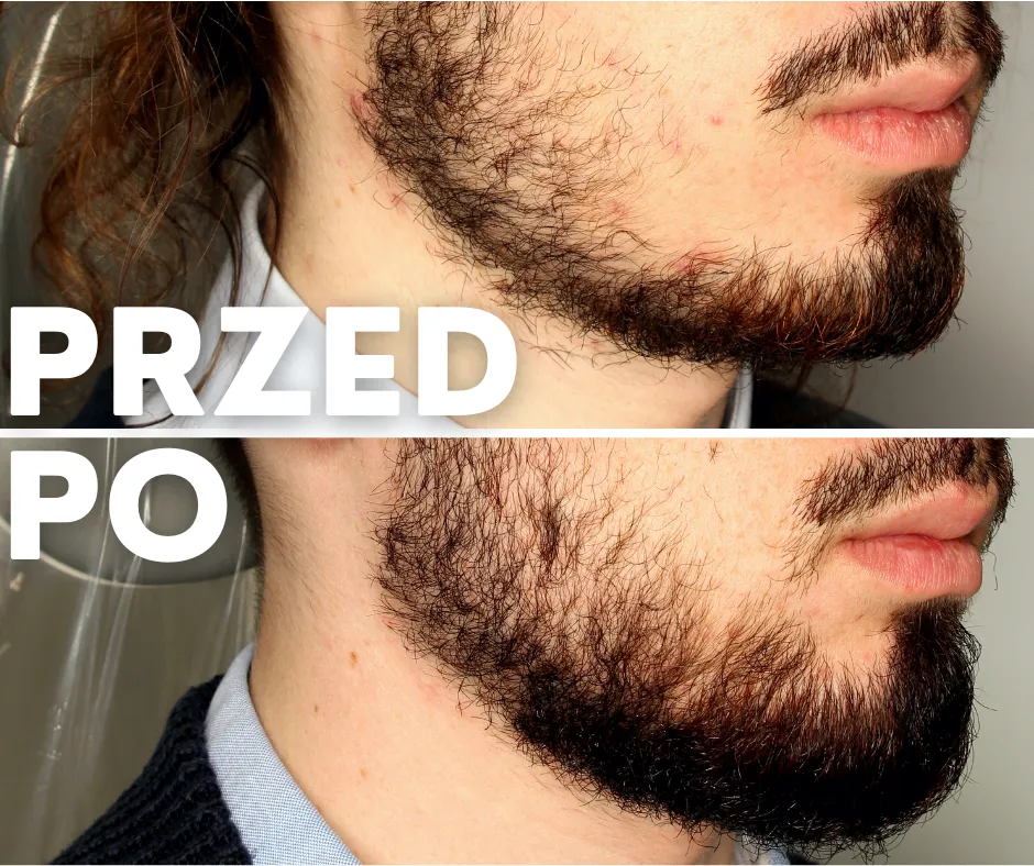 Jak skutecznie zapuścić zarost na policzkach i osiągnąć gęsty wygląd