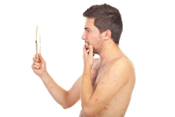 Jakie leki na ospę u dorosłych – skuteczne metody leczenia i ulga